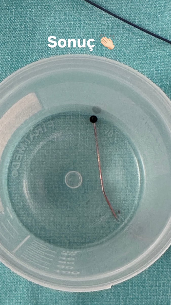 Başörtüsünü bağlamaya çalışan 14 yaşındaki hastamızın ağzında toplu iğne varken nefes almaya çalışması sonucu akciğerlerine kaçan iğneyi kurtarma operasyonu 👨‍⚕️🏃