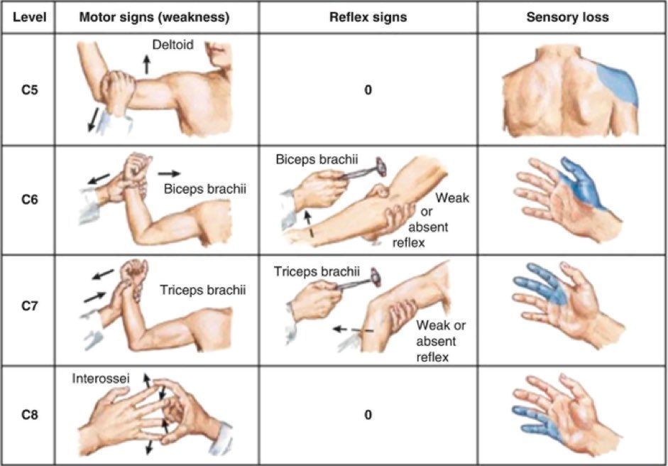 MoAImam's tweet image. Cervical Neurological Exam (C5 - C8)👇

#nerve #neuropathy

link.springer.com/chapter/10.100…