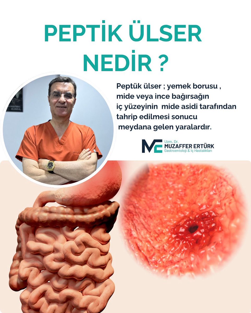Peptük ülser ; yemek borusu , mide veya ince bağırsağın 
iç yüzeyinin  mide asidi tarafından tahrip edilmesi sonucu
meydana gelen yaralardır.
#peptikülser #peptikülsertedavisi #ülsertedavisi #ülser #mideağrısı #midehastalıkları #gastroenterología #gastroenteroloji̇