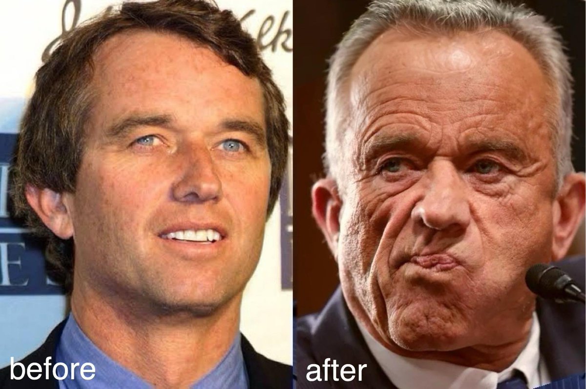 BREAKING: RFK Jr reveals his skincare routine involves regular foreskin grafts onto his face
