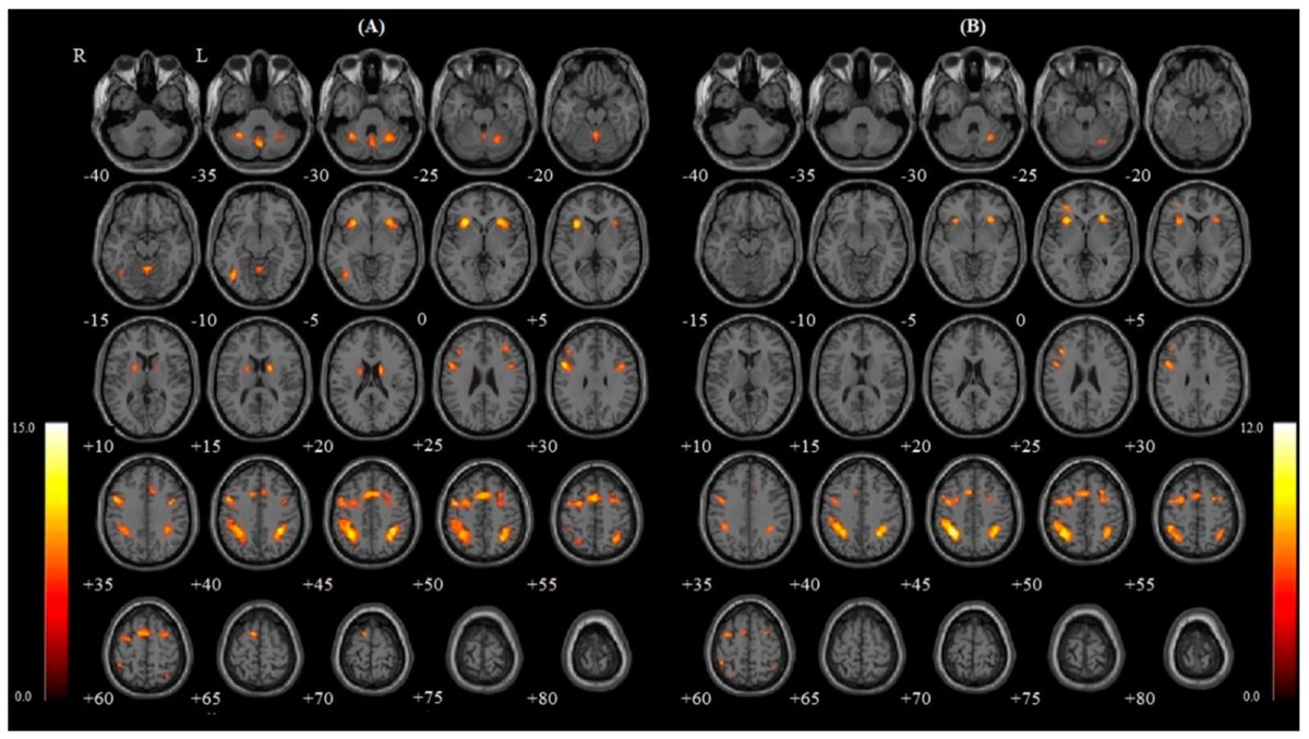 NTFabiano's tweet image. Mouth breathing is associated with lower brain activation &amp;amp; connectivity.
