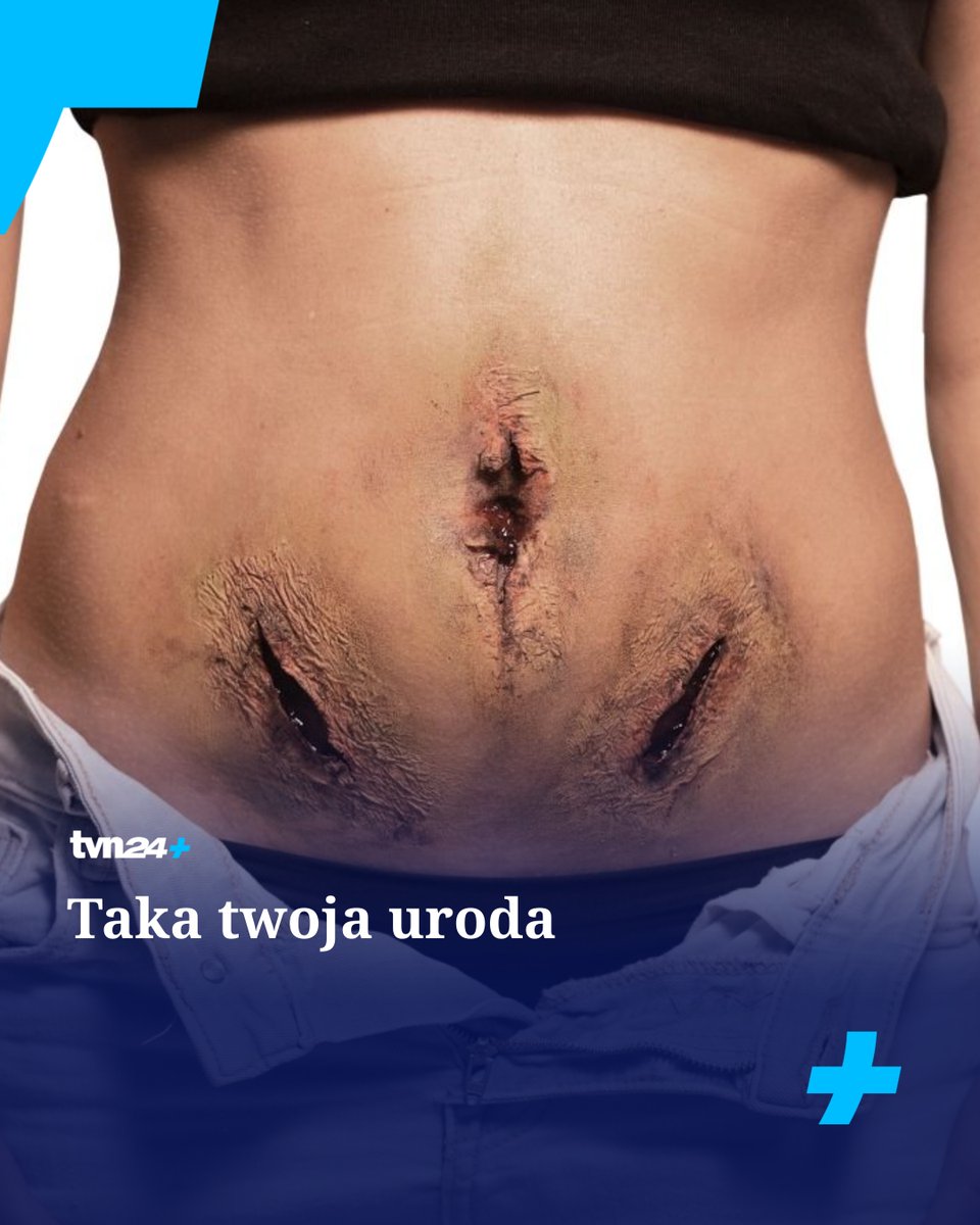 Przez lata problemy pacjentek cierpiących na endometriozę były bagatelizowane. Na ich sytuację zwróciły uwagę reporterki @faktytvn Katarzyna Górniak i <a href="/MagdaLucyan/">Magda Łucyan</a> w reportażu "Taka Twoja uroda" oraz książce "Taka twoja uroda. Jak endometrioza niszczy życie Polek". Po