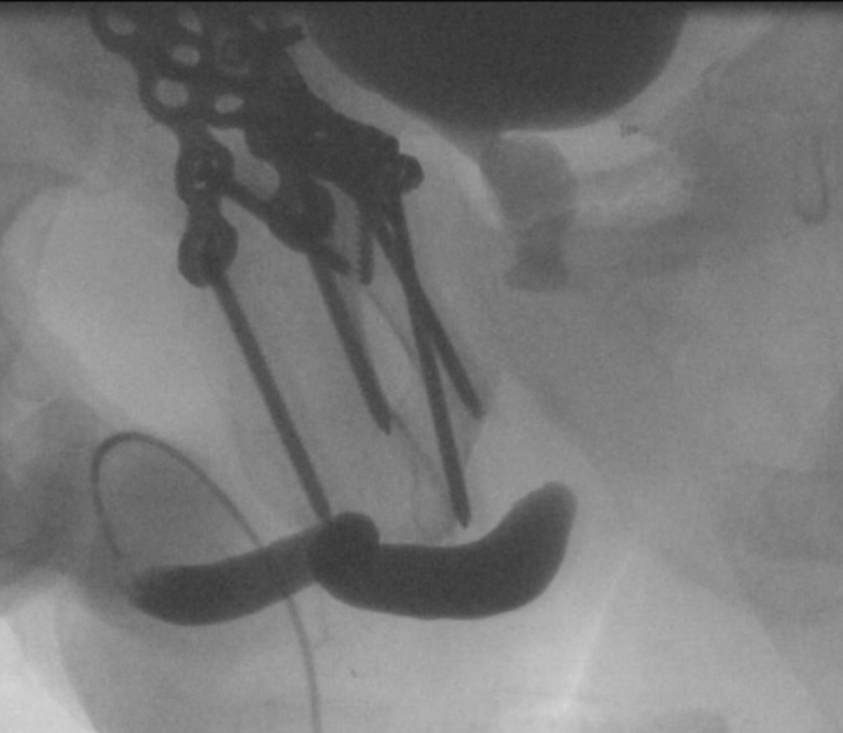 GursMasterclass's tweet photo. Last call – Submit your case or poster by Oct 19 to get free registration (3 slots left!) - https://t.co/HSr0ewh7rE 
Nov 5–7 | Online | Urethral Stricture Surgery
✔ 6 Live surgeries + NEW Semi-Live PFUI Step 4
@SocietyGURS @ISORU1 #Urology #MedEd
https://t.co/0iiGOwPrMa https://t.co/xwxwdXhYc0