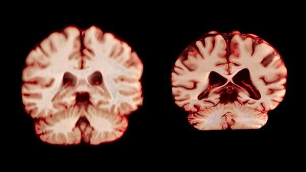 Dr. Claudio Zin (@zinclaudio) on Twitter photo El cerebro de la derecha es de un hombre de 75 años el de la izquierda de una mujer de la misma edad. La mujer tiene Alzheimer el hombre no. LA ATROFIA CEREBRAL NO SE RELACIONA CON EL ALZHEIMER. Lo cuento porque algunos médicos repiten y muestran imágenes de "pacientes" con El cerebro de la derecha es de un hombre de 75 años el de la izquierda de una mujer de la misma edad. La mujer tiene Alzheimer el hombre no. LA ATROFIA CEREBRAL NO SE RELACIONA CON EL ALZHEIMER. Lo cuento porque algunos médicos repiten y muestran imágenes de "pacientes" con