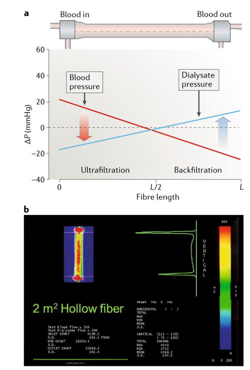 aldensanchez's tweet photo. Las membranas MCO no “filtran más”, filtran mejor:
🎯 Eliminan β₂M, IL-6 y mioglobina como la HDF
💧 Sin sustitución exógena
⚖️ Albúmina ↓ <4 g/sesión

#Nephrology #HDx #Nephpearls https://t.co/JqDYEC5N69