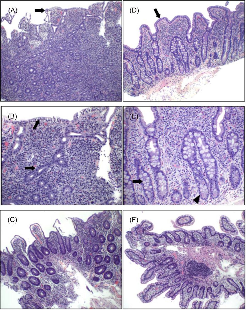 JPGNReports's tweet photo. From @allchildrens: A 16 yo's severe gut inflammation & wt loss looked like #autoimmune #enteropathy, but was caused by #Chlamydia! Antibiotics fixed it—no steroids!
🎗️ #Infections can perfectly mimic autoimmune disease. 🦠
🔗 https://t.co/5ia1Em954I
#OpenAccess #IDTwitter https://t.co/4YbZDl61uR