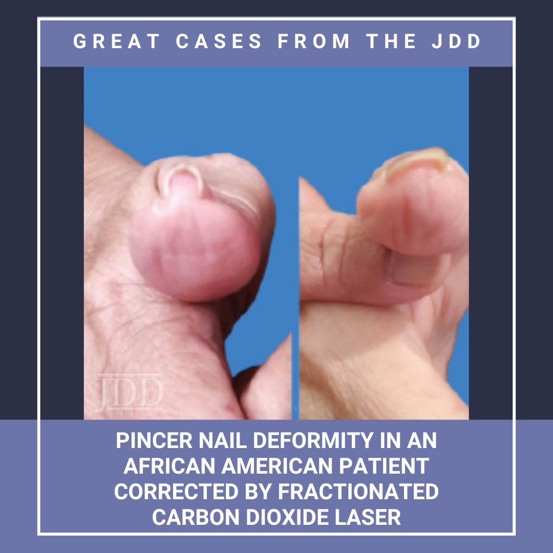 GREAT CASES FROM THE JDD: fCO2 laser improved a painful pincer thumbnail in a 78‑yr‑old African‑American patient (Fitzpatrick V), offering a less‑invasive option despite PIH risk in skin of color: ow.ly/VBwz50Xc2OQ

Content/images used with permission from the JDD