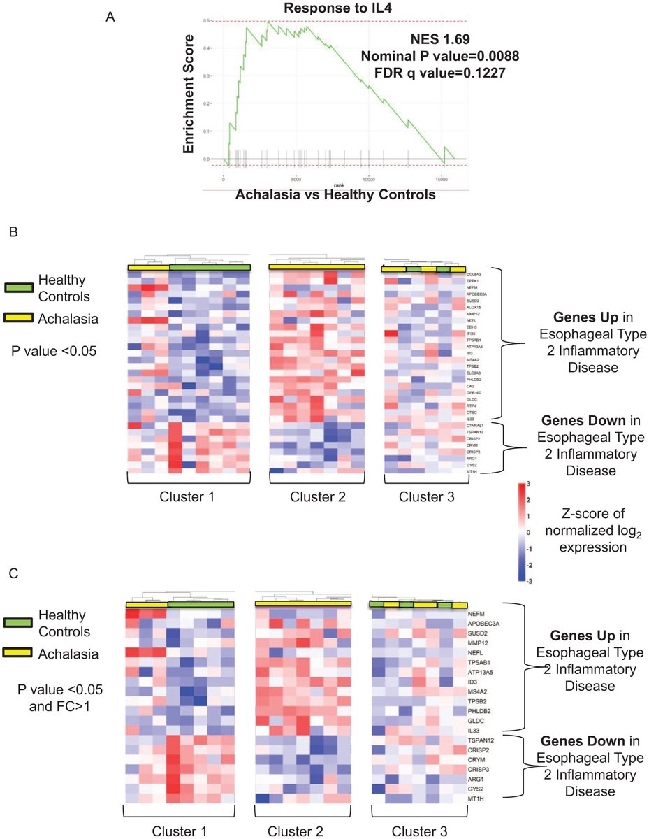 🆕 New in Foregut Journal

“Exploratory Transcriptome Analysis of Human Esophageal Mucosal Biopsies Reveals a Molecular Signature of Type 2 Inflammatory Signaling in Some Patients with Achalasia”

🔬 RNA-seq of mucosal biopsies found:
💥 Enrichment for IL-4–response genes
🧩 7 of