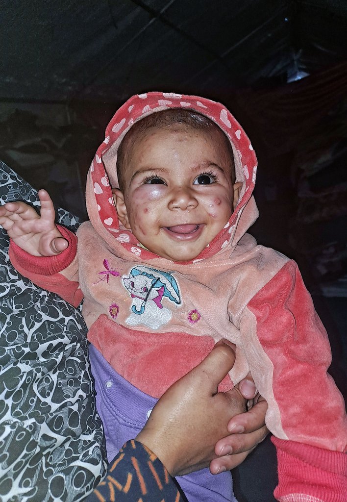 Stop for a moment… Tasneem hides a cry behind her swollen eye 💔 
I tried to make Tasneem laugh, but she is suffering from a painful swelling under her eye that makes it hard for her to even open her eyelid properly. She reaches her tiny hand to touch her eye… then cries