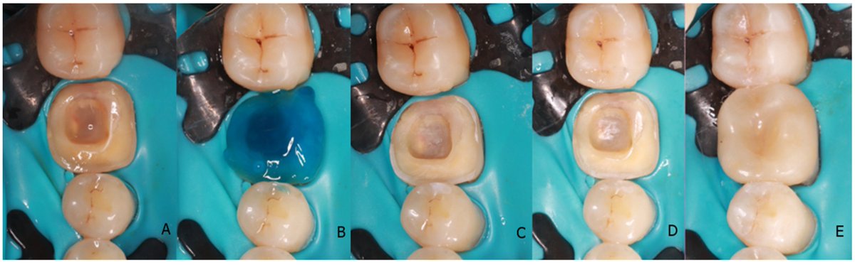 AdhesivesMDPI's tweet photo. 🦷 New in @AdhesivesMDPI

Endocrown Restoration for an Endodontically Treated Molar 🪞A detailed clinical guide with a 5-year follow-up 👏

🔗 https://t.co/2vq7L2EFbh

#Dentistry #Adhesives #RestorativeDentistry #MDPI #Endocrown #DentalResearch https://t.co/Qif8t0Jwha