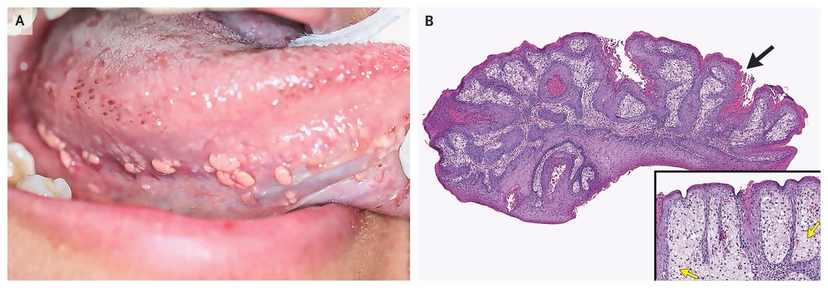 NEJM's tweet image. Images in Clinical Medicine: Oral Verruciform Xanthomas nej.md/4mH8U2I 

#DermTwitter