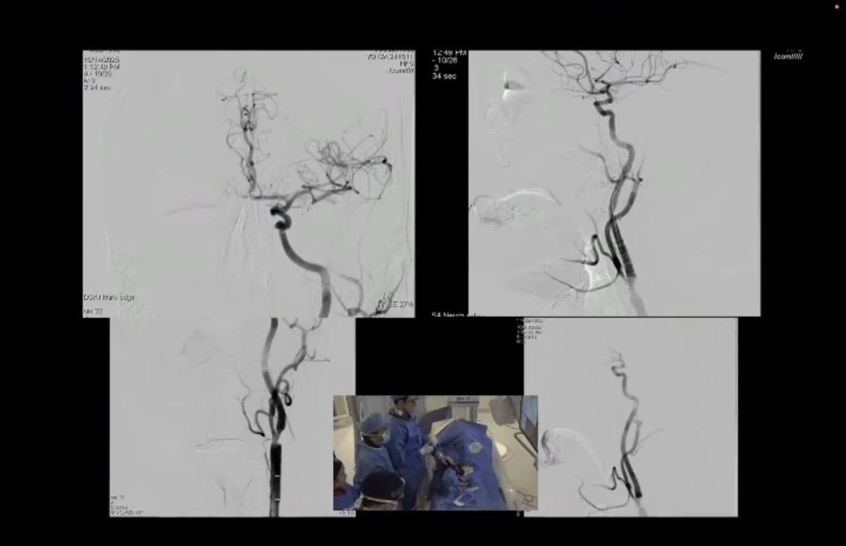 CNS_Update's tweet photo. Ground-breaking live surgery at #2025CNS yesterday! The first outpatient carotid stent placement in the US!
@EladLevyMD @UB_Neurosurgery https://t.co/s8UpXZFPTX