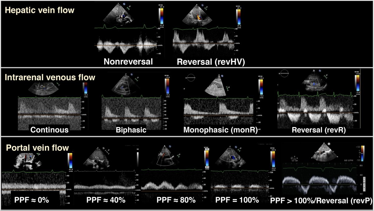 Characterization of hepatic, portal, and renal venous flow patterns by Doppler ultrasound across tricuspid regurgitation grades #REC #Aheadofprint <a href="/lvaroRodriperez/">Álvaro Rodríguez Pérez</a> <a href="/StructuralBCN/">Dabit Arzamendi</a> <a href="/manuelbarreirop/">Manuel Barreiro-Perez</a> <a href="/che_parada/">Checho Parada</a> <a href="/IForado/">Ilana Forado</a> @chpedroli revespcardiol.org/en-characteriz…