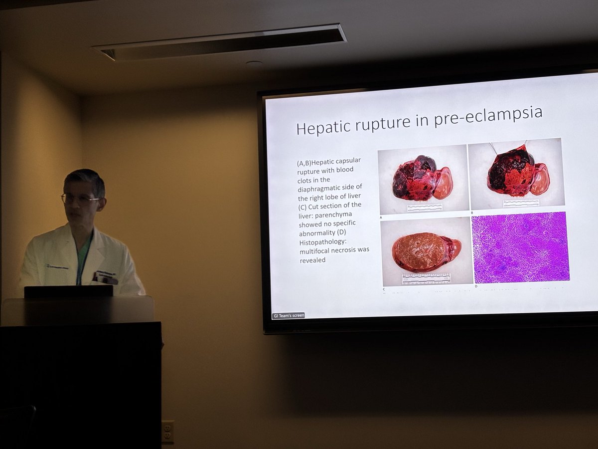 CreightonGI's tweet image. 🌟 All you need to know about liver diseases in pregnancy from our phenomenal Division Chief Dr. #SandeepMukherjee 👏
An excellent #GrandRounds lecture delivered this morning 🍾
#GITwitter #FutureOfGI
@Creighton @CreightonSOM @IMCreighton