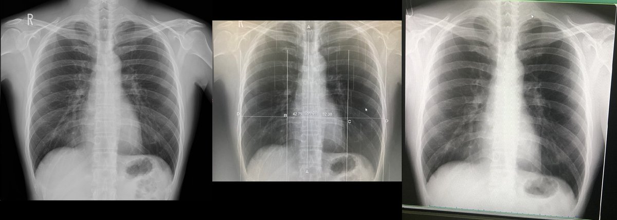 asuppo1's tweet image. レントゲン何枚かとってるけど
微妙な骨の透過具合の違いは、エックス線の量の違いなのかな？ 
心臓は小さめらしい。
 数値かいてあったりするけど、自分じゃわからない… 
握りやすいなら、手に取って握ってほしいな
#レントゲン #心臓 #x_ray