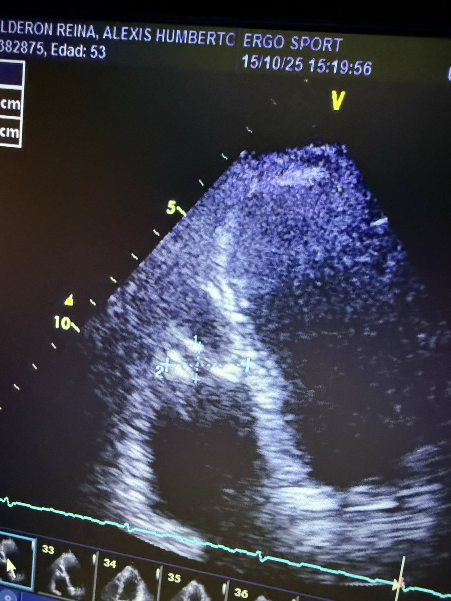 FabioTabares10's tweet photo. Masculino de 53 años, hace 5 meses perforación de colon durante colonoscopia, recibió antibiótico durante 7 días, en las últimas semanas episodios de sudoración nocturna. https://t.co/bSBTjHcV3Z