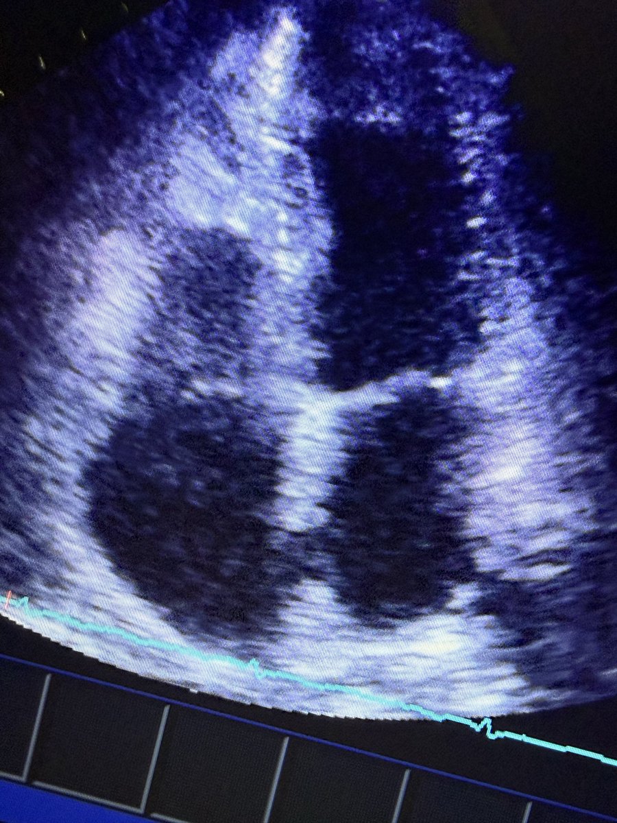 FabioTabares10's tweet photo. Masculino de 53 años, hace 5 meses perforación de colon durante colonoscopia, recibió antibiótico durante 7 días, en las últimas semanas episodios de sudoración nocturna. https://t.co/bSBTjHcV3Z