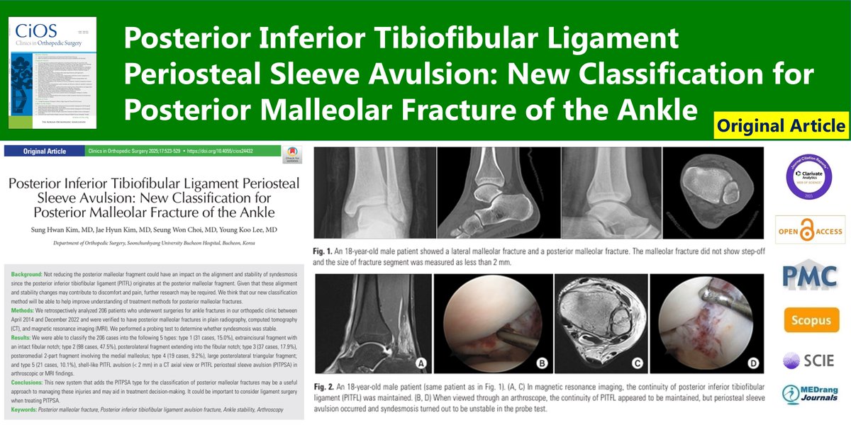 CiOSjournal's tweet image. Posterior Inferior Tibiofibular Ligament Periosteal Sleeve Avulsion: New Classification for Posterior Malleolar Fracture of the Ankle
🌷doi.org/10.4055/cios24…
Clin Orthop Surg. 2025 Jun;17(3) Sung Hwan Kim
#Posterior_malleolar_fracture #Ankle_stability #Arthroscopy