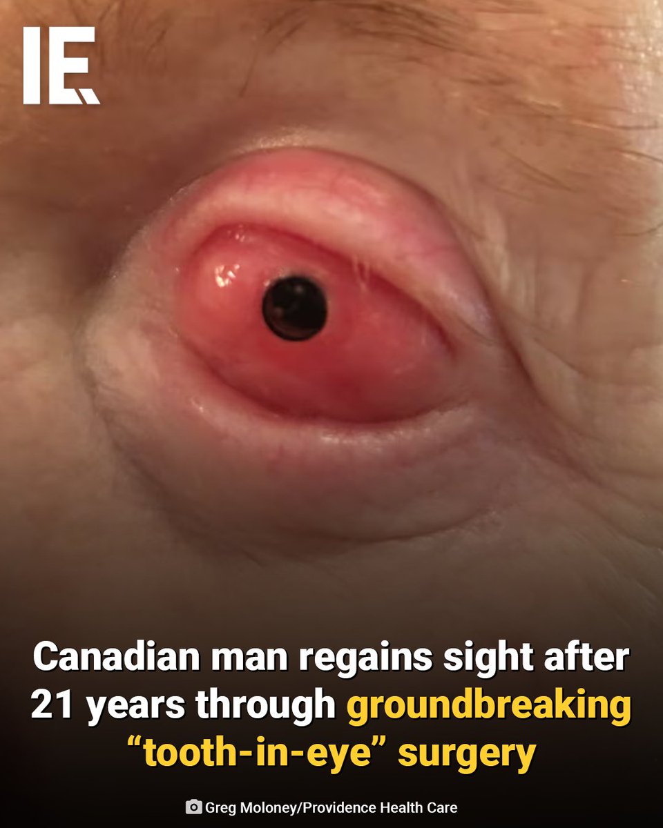 IntEngineering's tweet image. Brent Chapman from British Columbia lost his vision at 13 due to a severe reaction that left his eyes permanently damaged. After more than two decades of blindness and failed surgeries, he became one of the first Canadians to undergo osteoodontokeratoprosthesis, a procedure where…