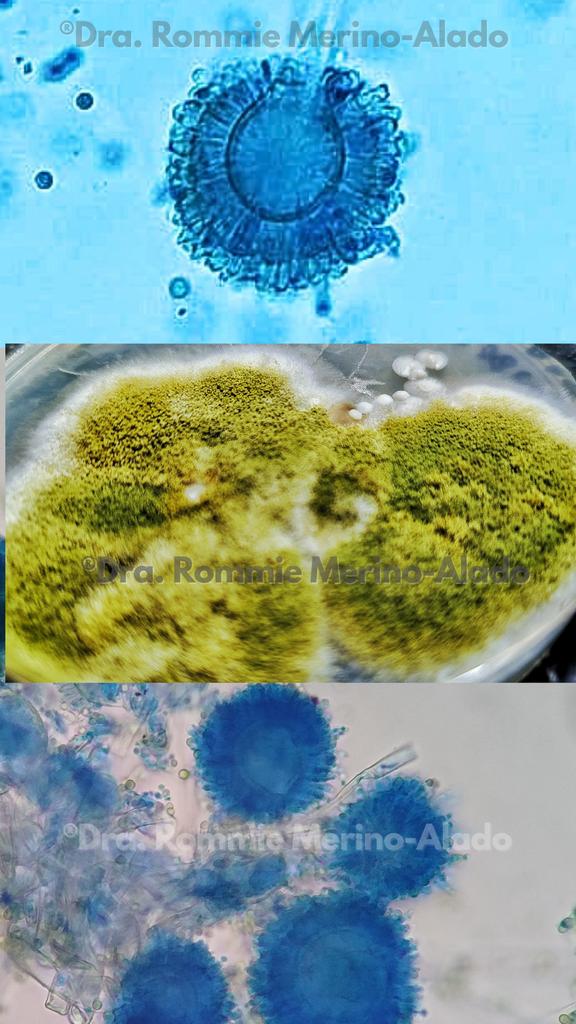 Aspergilosis case due to Aspergillus flavus (or newly named Aspergillus section flavi)