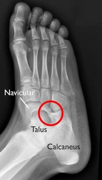 PodiatryMarket's tweet photo. 🤯 TARSAL COALITION MIND-BENDER: Cadaver studies show 13% of people have tarsal coalitions (fused foot bones), BUT 75% are totally asymptomatic. Your foot could have bones fused together right now and you’d never know. Some bodies just don’t care about “abnormal” anatomy. 🦶 https://t.co/sXZPSjmz81