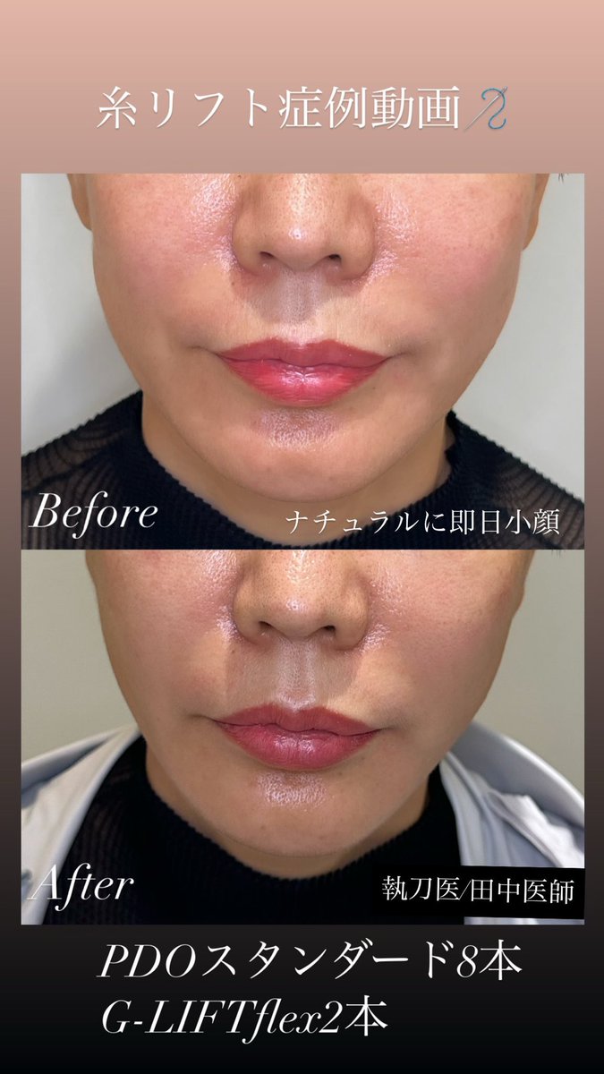 ELAICE フェイスリフト Ginza 78Clinic on X