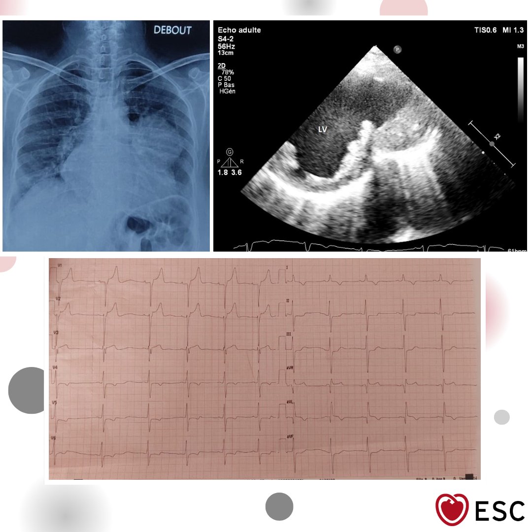escardio's tweet image. #ImageOfTheWeek by Oualid Kerrouani, Mohamed Sarsari and Jamila Zarzur from Ibn Sina University Hospital, Rabat, Morocco.
The patient is an elderly woman, post-anterior MI with dyspnoea. 

What is your echo diagnosis? ow.ly/gqbV50XbxIi

#cardioed
