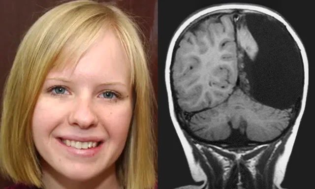 nextstepspeech's tweet image. INSPIRATION💡
Christina Santhouse had half of her brain removed at age 8 to stop constant seizures. Doctors said she’d never drive or live a normal life. She got her license at 17, earned both her bachelor's and master's degrees in just 5 years, and became a speech pathologist