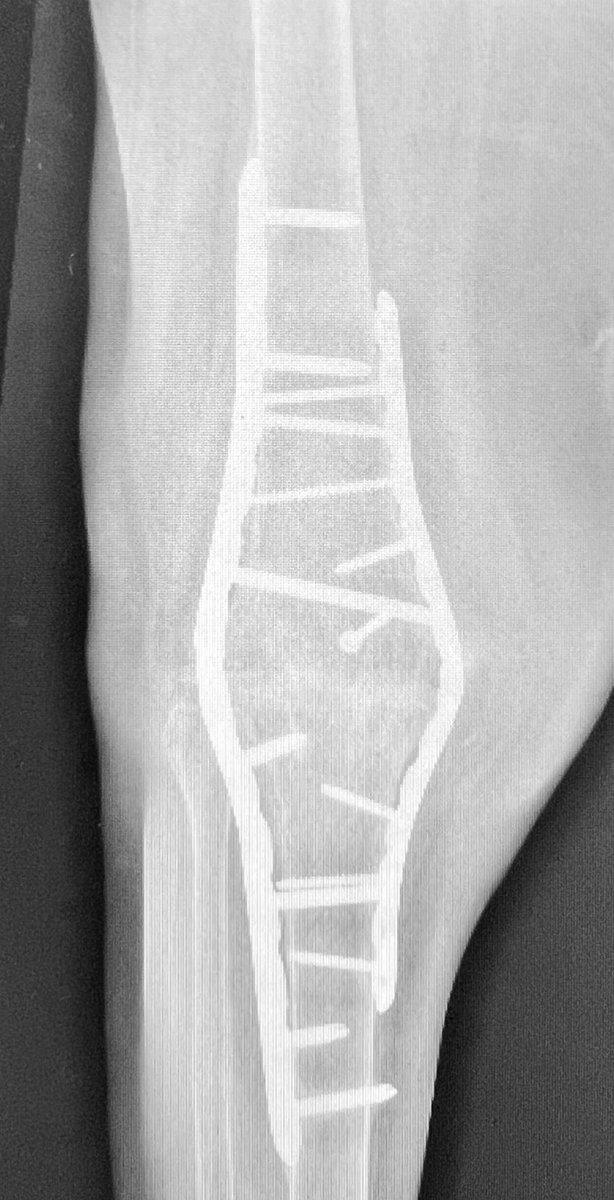 centerofhip's tweet image. My preferred construct for a knee fusion. Usually I use TKR cutting blocks. Common mistake is for the knee to go to hyperextension. Use a 4.5 narrow plate laterally and 3.5 medially to reduce implant prominence.  Can use patella as a graft bridging the joint.  
#orthotwitter