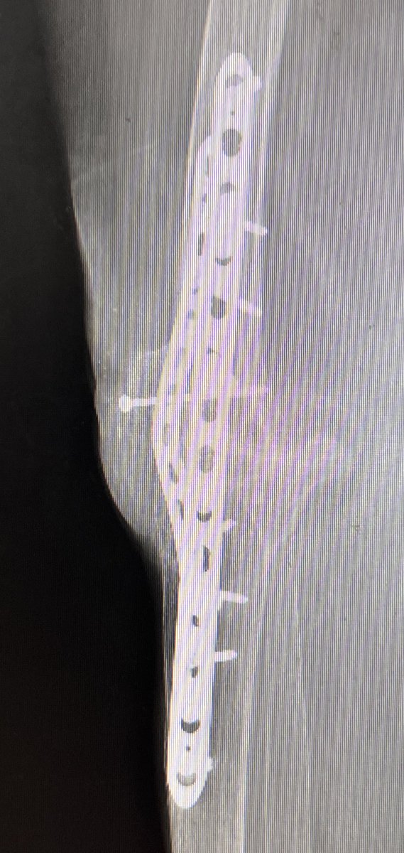 centerofhip's tweet image. My preferred construct for a knee fusion. Usually I use TKR cutting blocks. Common mistake is for the knee to go to hyperextension. Use a 4.5 narrow plate laterally and 3.5 medially to reduce implant prominence.  Can use patella as a graft bridging the joint.  
#orthotwitter