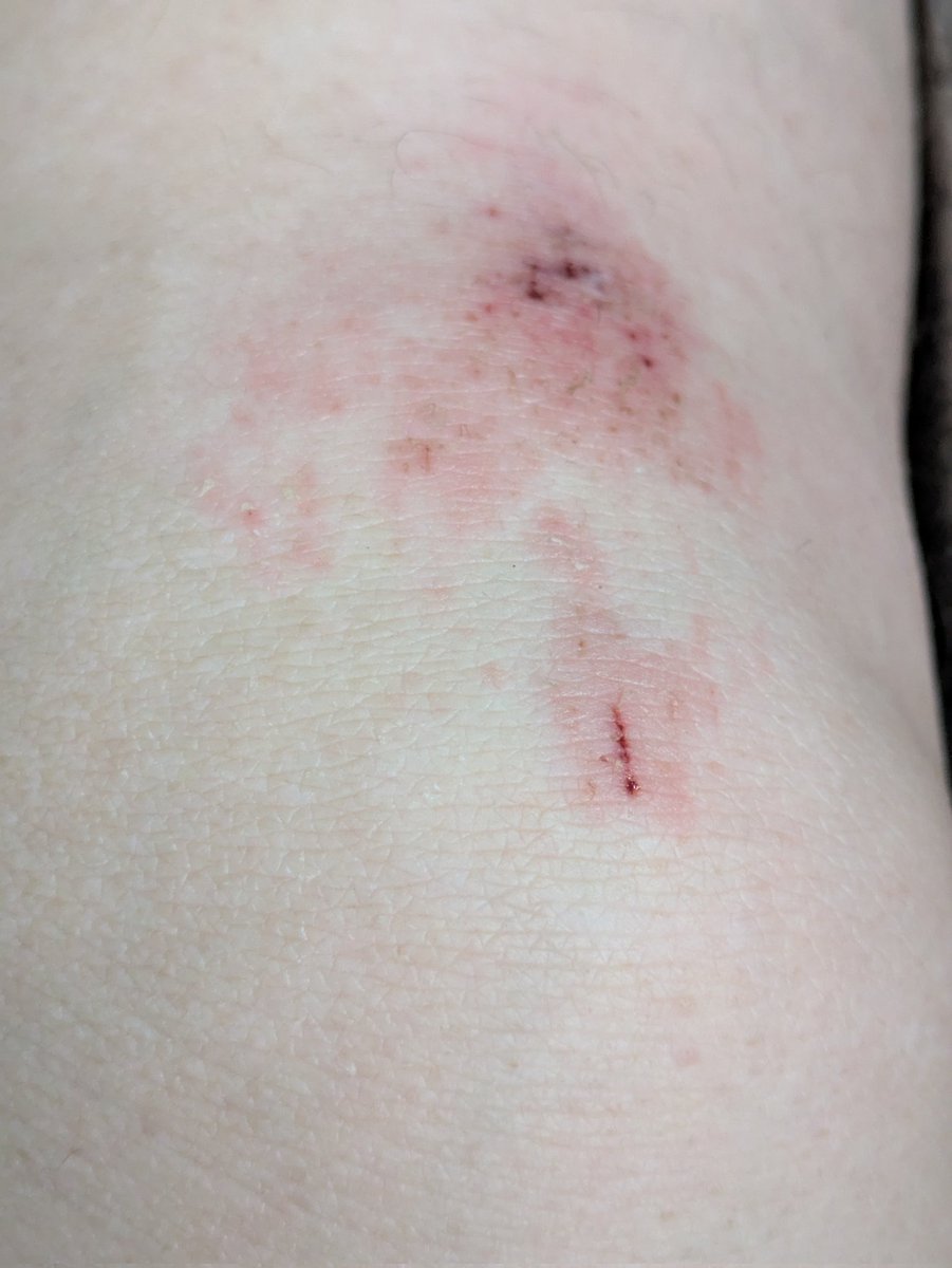 Well, my knee is looking pretty colourful so far today. Heckin' sore,though.