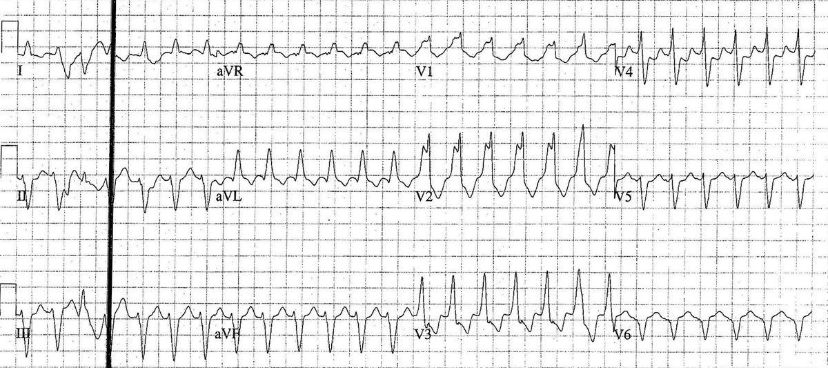 ManualOMedicine's tweet image. This ECG is from an 83 y/o male patient who presented with shortness of breath.
- What&apos;s the rhythm ?

#medtwitter #foamed #cardioed