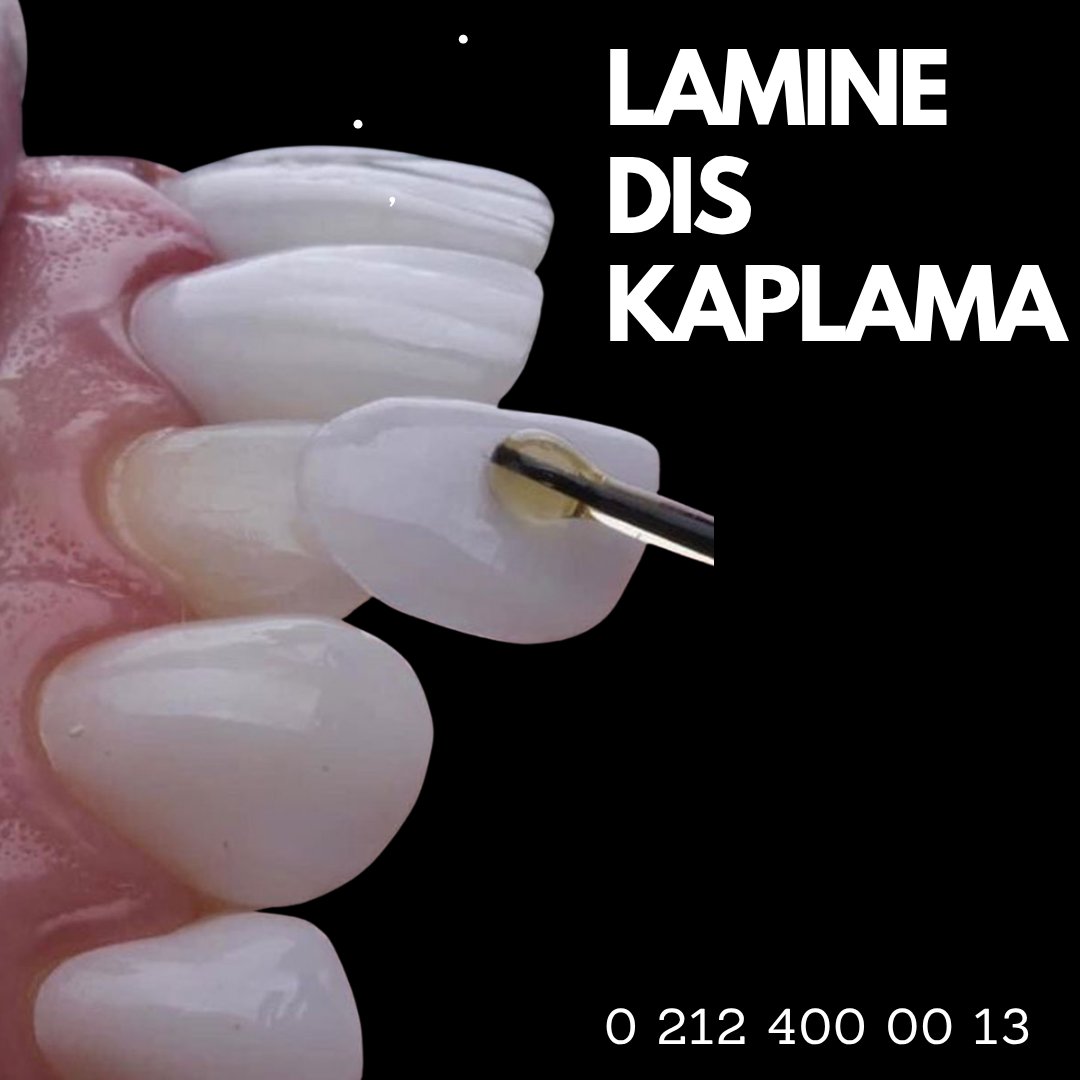 YucelerHealthAS's tweet photo. Lamine Diş Kaplama (Yaprak Porselen Diş Kaplama) https://t.co/kBeCZRBOIG