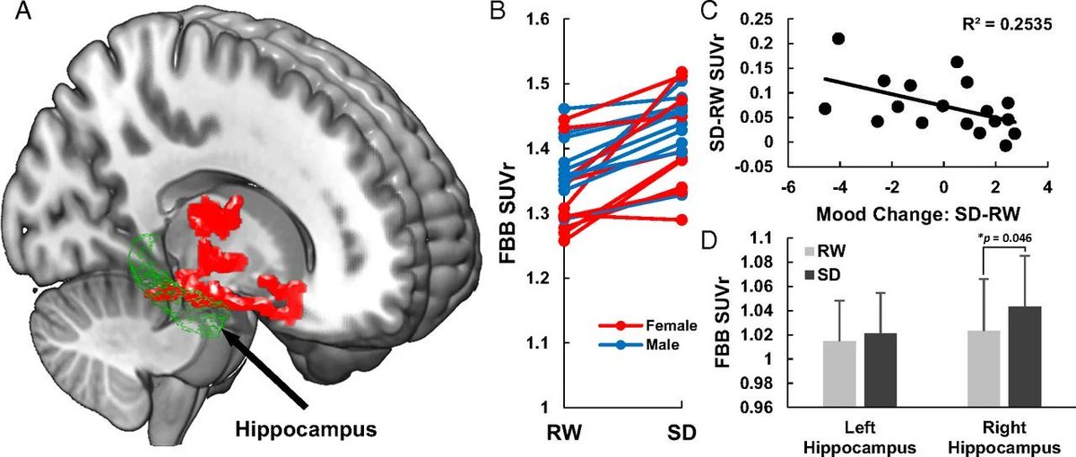 After one night of sleep deprivation the brain begins to accumulate β-amyloid.

This is a key protein in Alzhiemer’s dementia.