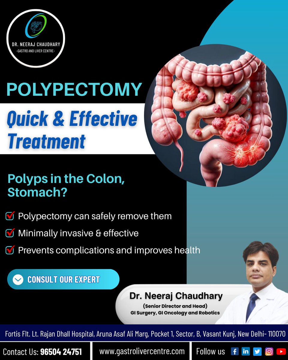 gastroandliverc's tweet image. ✨ Say Goodbye to Colon &amp;amp; Stomach Polyps!
.
Consult Dr. Neeraj Chaudhary, Best Pancreatic Surgeon in Vasant Kunj
.
📞 96504 24751, 84471 27840
.
#DigestiveHealth #Polypectomy #DigestiveHealth #ColonCare #StomachHealth #GastroCare #WhippleSurgery #DigestiveCare #GallbladderDisease