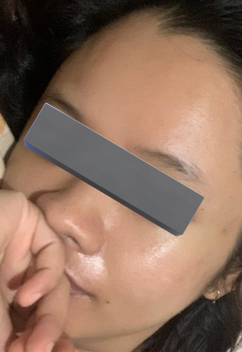 choihanie's tweet photo. kondisi kulit aku tahun 2019 (pic 1 dan 2)
vs
kondisi kulit aku sekarang (pic 3)

aku mau sharing produk apa aja yang aku pake, dan kebiasaan apa yang aku ubah berdasarkan pengalaman aku 🙏 https://t.co/c3aWm475un
