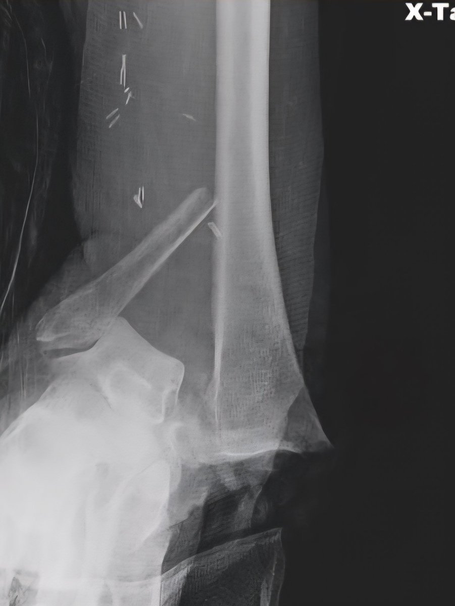 davidhcmd's tweet image. How do you manage severe ankle fracture dislocations in the geriatric population?
@otatrauma Breakout session Thursday 230pm Room 222 will cover Strategies & Techniques to address this challenge, moderated by Dr. Abhishek Ganta
ota.org