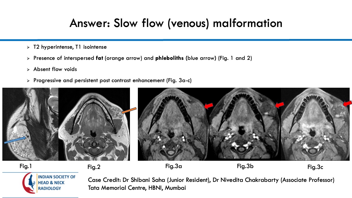 teamishnr's tweet image. #caseoftheweekanswer
Please find the answer
#radiology #caseoftheweek #headandneck #radiologycases #dailywork #ISHNR #teaching #research #imaging #FOAM #FOAMRad #FOAMMed
Visit our website: ishnr.com/case-151/
All Cases: ishnr.com/case/