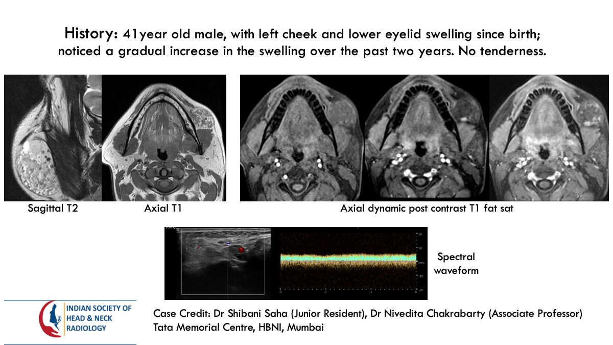 teamishnr's tweet image. #caseoftheweekanswer
Please find the answer
#radiology #caseoftheweek #headandneck #radiologycases #dailywork #ISHNR #teaching #research #imaging #FOAM #FOAMRad #FOAMMed
Visit our website: ishnr.com/case-151/
All Cases: ishnr.com/case/