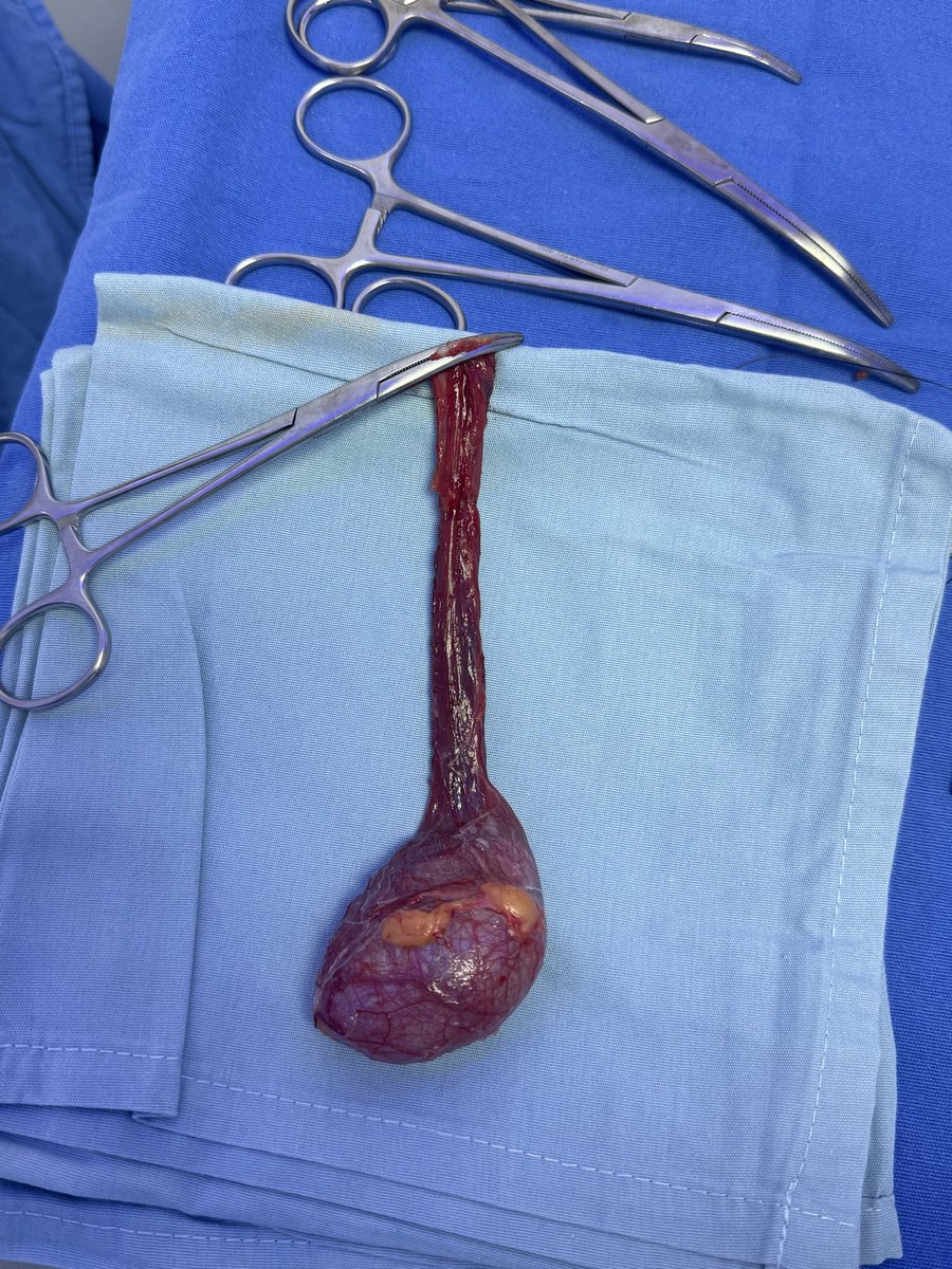 urotelio's tweet image. Oquiectomía radical por Cáncer de testículo.

Padecimiento que detectado a tiempo tiene tasas de curación altas.

#Tócate 

#Cancer #Testículo