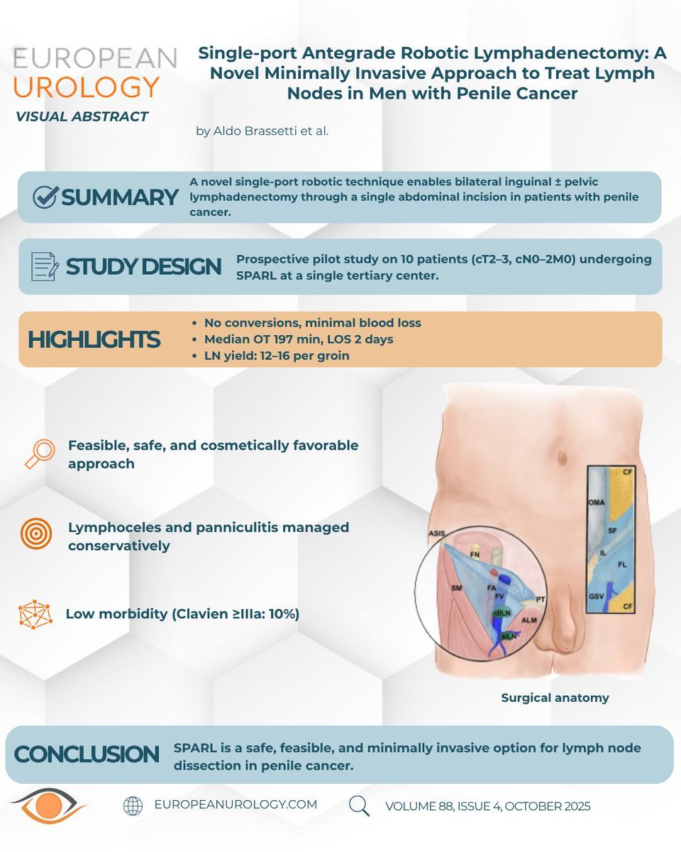 🚀 New in European Urology – Surgery in Motion
Single-port Antegrade Robotic Lymphadenectomy (SPARL): a new frontier for minimally invasive management of lymph nodes in penile cancer.

Through a single infraumbilical incision, SPARL allows bilateral inguinal ± pelvic