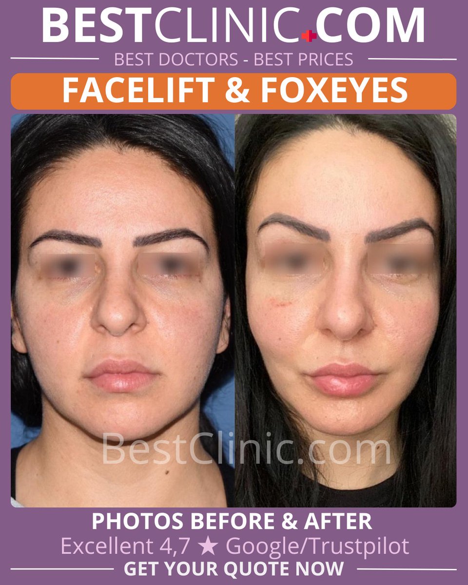 BestClinic_com's tweet image. ✨ Achieve a Youthful Glow with Facial Lift &amp;amp; Fox Eyes in Turkey, Tunisia &amp;amp; Spain ✨
Get a quote 👉 bestclinic.com/facelift-turkey
Lift sagging skin, smooth wrinkles, and sculpt elegant fox eyes for a radiant, refreshed look 🌸💆‍♀️👁️
#FacialLift #FoxEyes