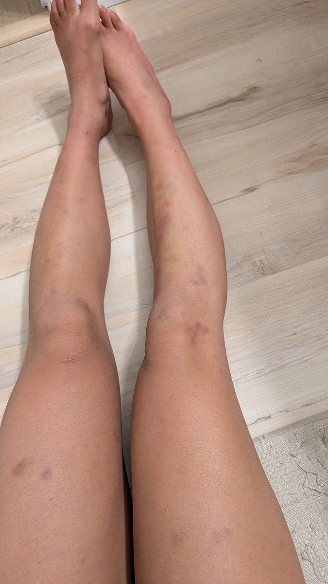 I didn't know one BJJ class could cause this much damage 😅