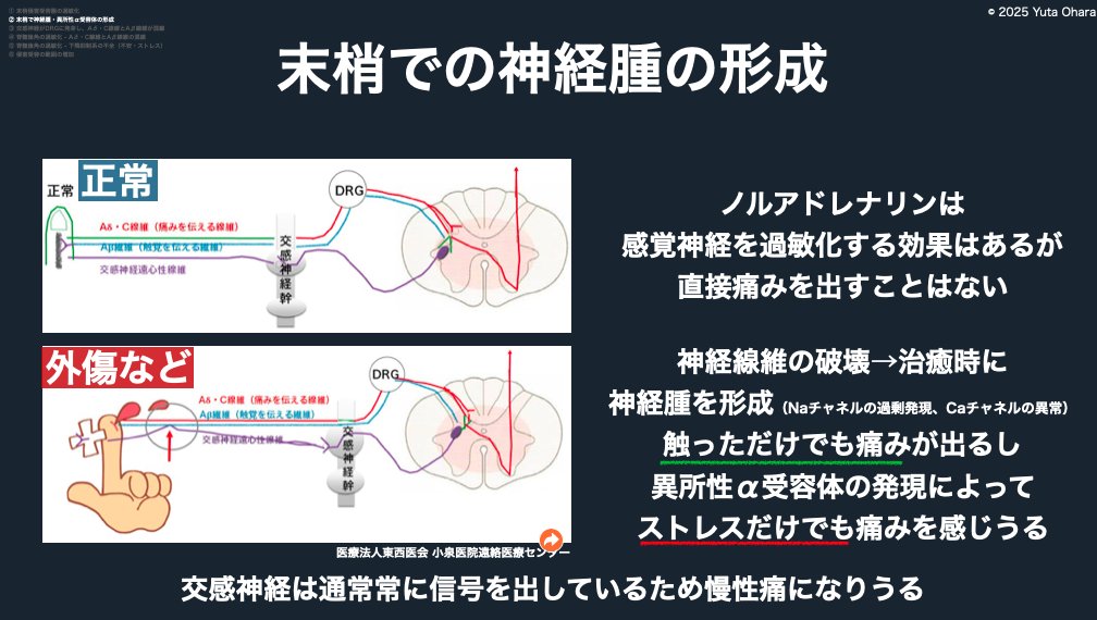 yuuta023's tweet photo. 🦷2025/10/24 Dr向け

切断された神経が痛みを発生させる仕組み

切断された神経は再生し（また伸びてくる）、まとまって神経腫＋異所性αアドレナリン受容体を作ることがあります💣

この受容体にノルアドレナリンが作用すると、活動電位が生じて疼痛閾値を超えると痛みとして認識されます

交感神経は常に信号を出しているため、これが末梢性の慢性痛の原因になる可能性があります🚥

また、古傷が傷むというのもこの神経腫が原因となる場合があります⚡️

根管治療というのは根尖部で神経を切断しているため稀にこのような神経腫の形成を起こし

難治性の痛みの1つの原因として認識されています

痛みの診査・診断ウェビナー（振り返り視聴つき）
https://t.co/LwdNBVnBCZ

歯科論文と歯科でのAI活用をわかりやすく教えるオンラインスクール
https://t.co/QFZNE5F8tI