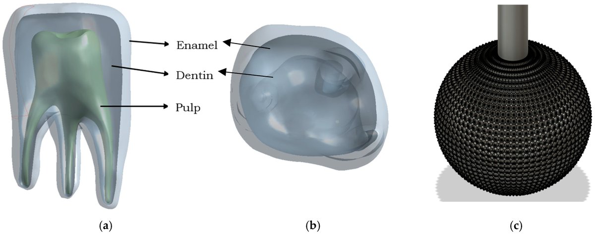 Prosthesis_MDPI's tweet image. This study uses finite element analysis to assess stress in dental structures during cavity prep with diamond burs—key insights for better care!
Details via DOI: doi.org/10.3390/prosth… 🦷💎🔬
#DentalBiomechanics #FiniteElementAnalysis #DentalInstrumentResearch