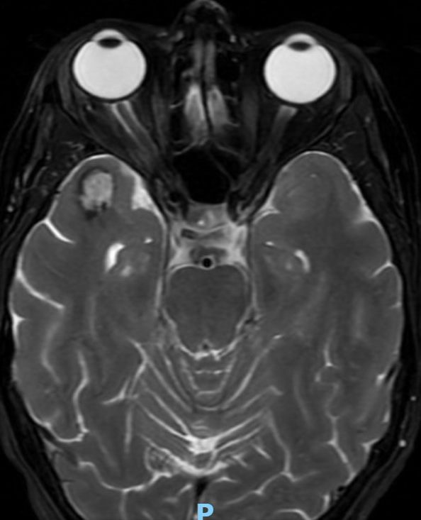 whitfieldlewis6's tweet photo. 🧠 Case
A 40-year-old presents with new-onset seizures and a longstanding history of recurrent headaches with symptom-free intervals between episodes.

🩻 Imaging Finding
On both T2 and T1 axial MRI sequences, there is a well-circumscribed, multilobulated lesion in the right temporal lobe with a heterogeneous “popcorn” core (on T2) and peripheral hypointense rim (hemosiderin).
The hypointense rim represents old blood, typically seen at the periphery; chronic blood products are dark on MRI because of hemosiderin deposition.
➡️ Classic appearance of a cavernous malformation (cavernoma).

⚡ Likely Cause of Seizures
Temporal-lobe seizures secondary to cavernous malformation.
Chronic microhemorrhages → cortical irritation → epileptogenic focus.
The intermittent headaches likely reflect recurrent small bleeds.
💭 What are the treatment options?
#Neurology #Neuroradiology #Neurosurgery #Seizures