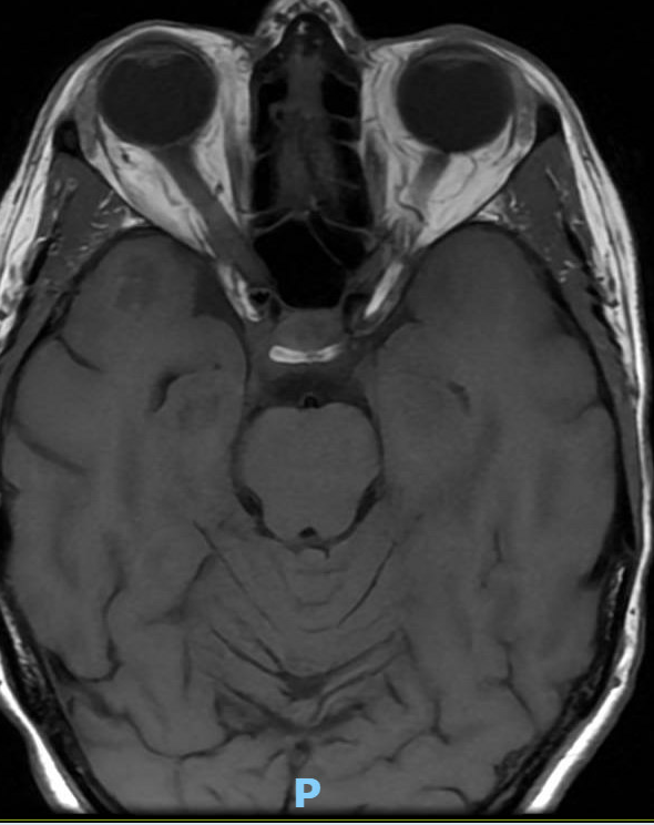 whitfieldlewis6's tweet photo. 🧠 Case
A 40-year-old presents with new-onset seizures and a longstanding history of recurrent headaches with symptom-free intervals between episodes.

🩻 Imaging Finding
On both T2 and T1 axial MRI sequences, there is a well-circumscribed, multilobulated lesion in the right temporal lobe with a heterogeneous “popcorn” core (on T2) and peripheral hypointense rim (hemosiderin).
The hypointense rim represents old blood, typically seen at the periphery; chronic blood products are dark on MRI because of hemosiderin deposition.
➡️ Classic appearance of a cavernous malformation (cavernoma).

⚡ Likely Cause of Seizures
Temporal-lobe seizures secondary to cavernous malformation.
Chronic microhemorrhages → cortical irritation → epileptogenic focus.
The intermittent headaches likely reflect recurrent small bleeds.
💭 What are the treatment options?
#Neurology #Neuroradiology #Neurosurgery #Seizures