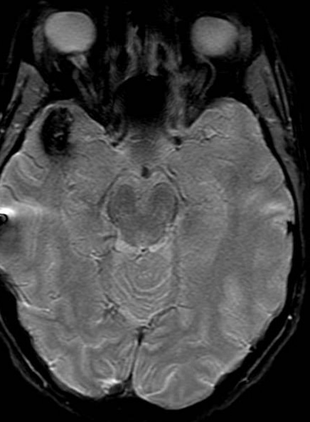 whitfieldlewis6's tweet photo. 🧠 Case
A 40-year-old presents with new-onset seizures and a longstanding history of recurrent headaches with symptom-free intervals between episodes.

🩻 Imaging Finding
On both T2 and T1 axial MRI sequences, there is a well-circumscribed, multilobulated lesion in the right temporal lobe with a heterogeneous “popcorn” core (on T2) and peripheral hypointense rim (hemosiderin).
The hypointense rim represents old blood, typically seen at the periphery; chronic blood products are dark on MRI because of hemosiderin deposition.
➡️ Classic appearance of a cavernous malformation (cavernoma).

⚡ Likely Cause of Seizures
Temporal-lobe seizures secondary to cavernous malformation.
Chronic microhemorrhages → cortical irritation → epileptogenic focus.
The intermittent headaches likely reflect recurrent small bleeds.
💭 What are the treatment options?
#Neurology #Neuroradiology #Neurosurgery #Seizures