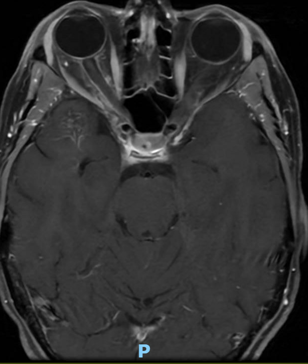 whitfieldlewis6's tweet photo. 🧠 Case
A 40-year-old presents with new-onset seizures and a longstanding history of recurrent headaches with symptom-free intervals between episodes.

🩻 Imaging Finding
On both T2 and T1 axial MRI sequences, there is a well-circumscribed, multilobulated lesion in the right temporal lobe with a heterogeneous “popcorn” core (on T2) and peripheral hypointense rim (hemosiderin).
The hypointense rim represents old blood, typically seen at the periphery; chronic blood products are dark on MRI because of hemosiderin deposition.
➡️ Classic appearance of a cavernous malformation (cavernoma).

⚡ Likely Cause of Seizures
Temporal-lobe seizures secondary to cavernous malformation.
Chronic microhemorrhages → cortical irritation → epileptogenic focus.
The intermittent headaches likely reflect recurrent small bleeds.
💭 What are the treatment options?
#Neurology #Neuroradiology #Neurosurgery #Seizures