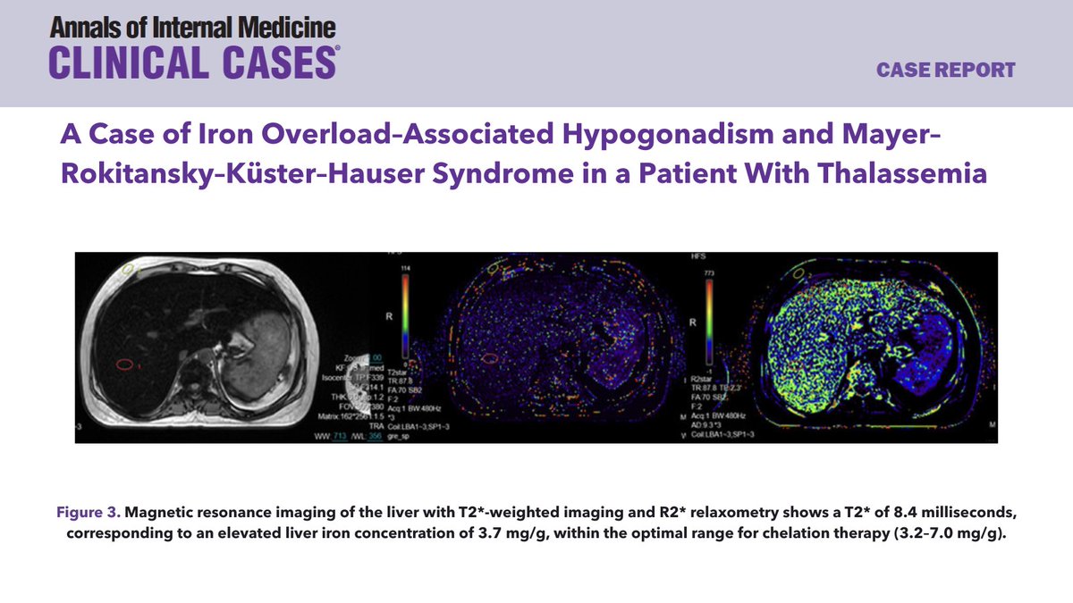 Online now: A Case of Iron Overload–Associated Hypogonadism and Mayer–Rokitansky–Küster–Hauser Syndrome in a Patient With Thalassemia bit.ly/4naYkkT <a href="/AHAScience/">AHA Science</a> #AHAJournals